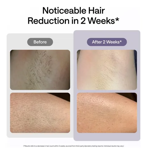 Ipl Hair Removal Device Ulike Air 10 For Women And Men