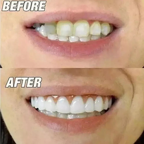 Nuevo 2 Juegos De Dentaduras Postizas De Silicona Simuladas