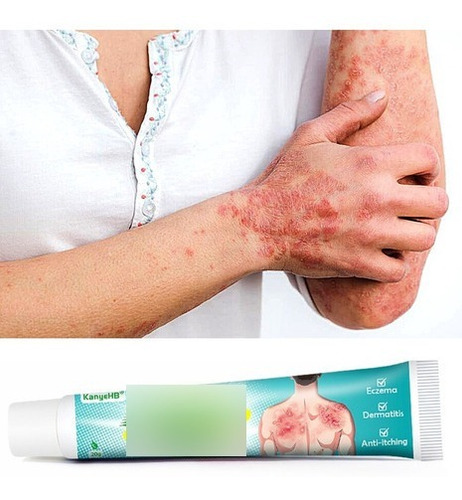 Dermatite Palpebral