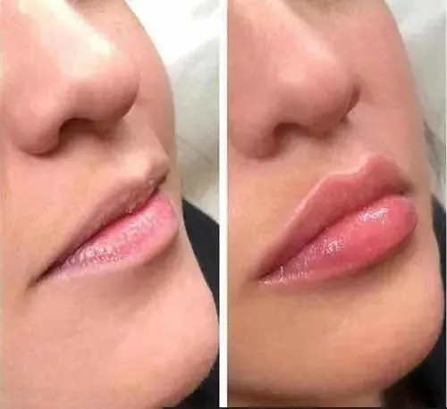 Engrosador De Labios Lip Plumping Balm C/acido Hialuronico