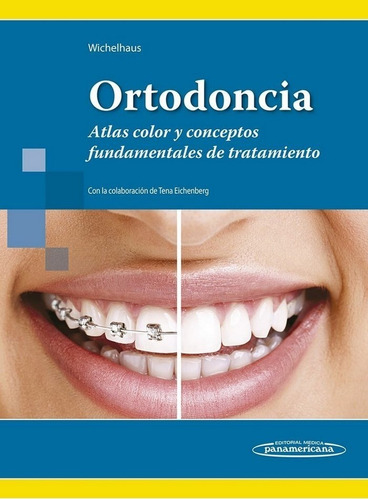 Ortodoncia - Wichelhaus