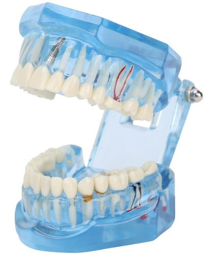 Modelo De Dientes Dentales De Acrílico Azul Transparente