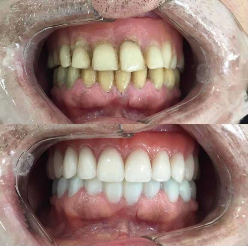 Imagem 3 de 4 de Implantes Dentários