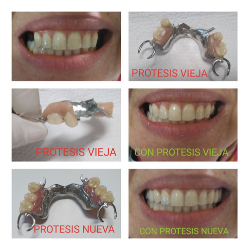 Imagen 1 de 5 de Prótesis Dentales - Dentista - Placas Contencion Y Bruxismo