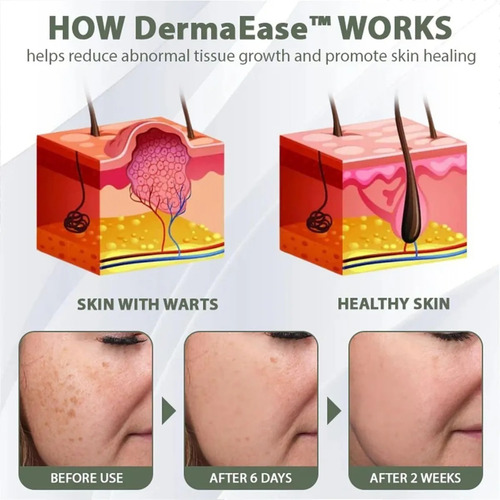 Gel Eliminador Instantáneo De Lunares Y Manchas, Gel Elimina