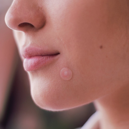 Imagen 3 de 4 de Coony Acne Fast Clear Patch Tratamiento Parches P/ Granitos