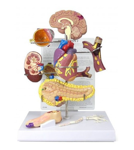 Maqueta Anatómica De Diabetes Tipo 2 - Alta Calidad