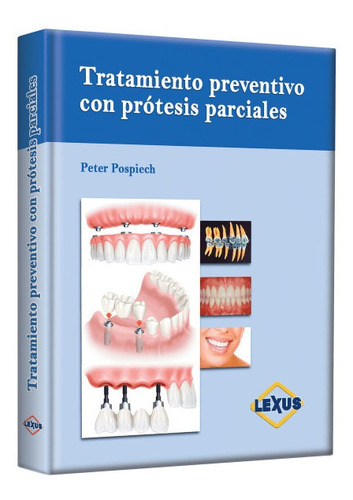 Tratamiento Preventivo Con Prótesis Parciales