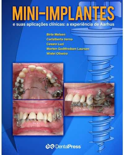 Mini-implantes E Suas Aplicações Clinicas: A Experiência De Aarhus, De Birte Melsen. Editora Dental Press, Capa Mole, Edição 1 Edição Em Português, 2017