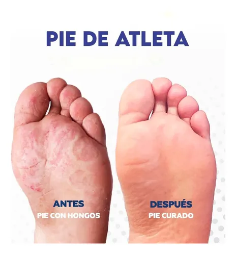 Gotas Hongos Pie De Atletas