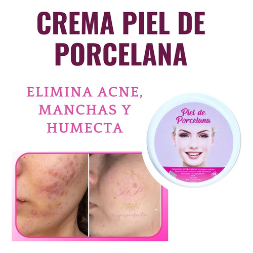 Piel De Porcelana Combate Las Manchas Y Cicatrices Anti Acne