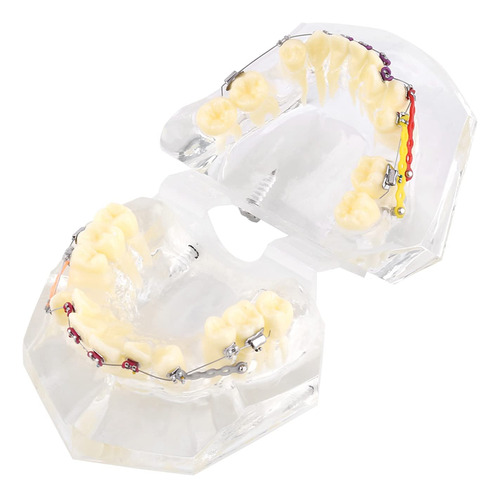 Modelo De Soportes, Modelo Dental, Tratamiento De Ortodoncia