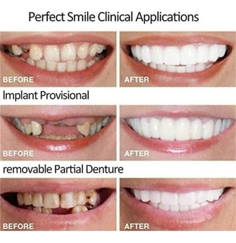 Las Dentaduras Postizas Heolien Te Hacen Sonreír