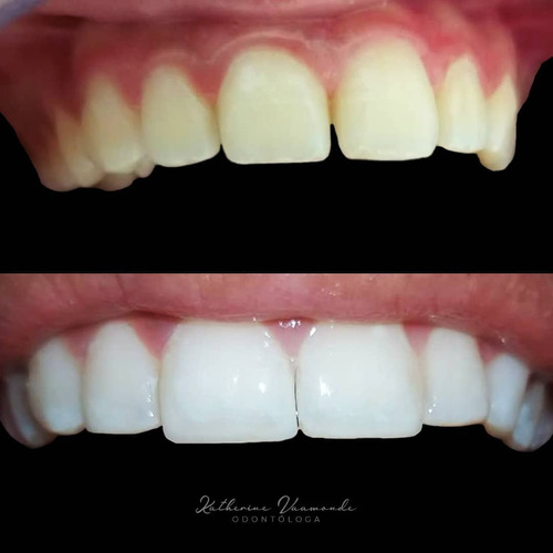 Imagen 1 de 5 de Blanqueamiento Dental. Carillas. Diseño De Sonrisa. Resinas