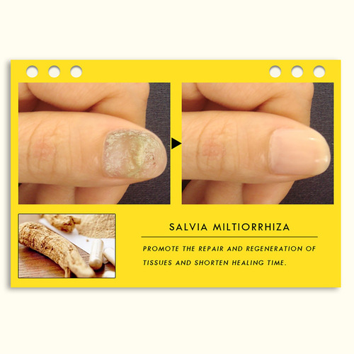 Crema Para Hongos En Las Uñas, Cuidado De Los Pies, Antimicó