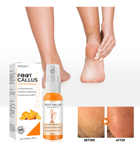 Aerosol Para Eliminar Callos N Foot, Spray Exfoliante Para P