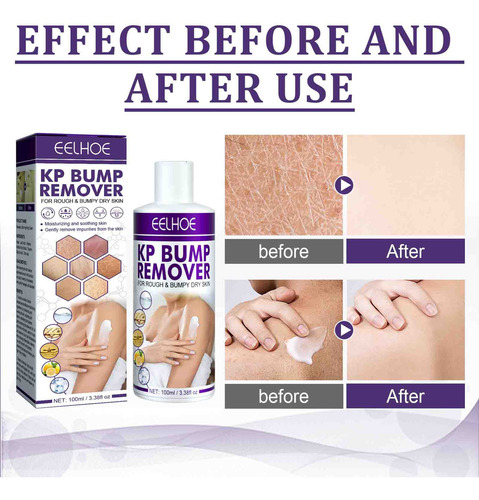 Alivian Eficazmente La Queratosis Folicular,crema Hidratante