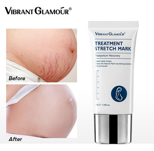 Creme Para Remoção De Padrões Para Estrias Scar Striae Gravi
