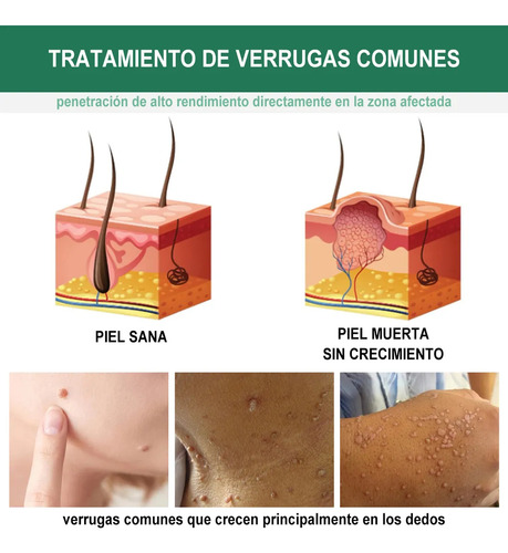 Tratamiento Y Eliminación De Verrugas Y Vph