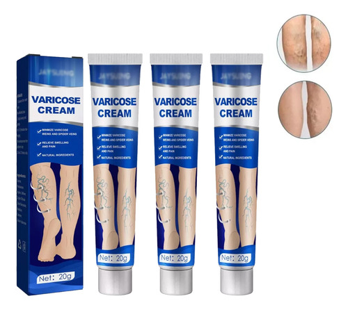 Variz Flebite Varicocele Telangiectasia - g a $986