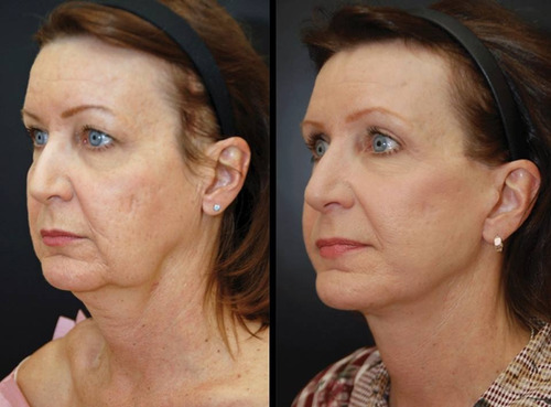 Skindulgence Rejuvenecimiento Facial Sin Cirugía 30 Min Tipo De Piel Todo Tipo De Piel