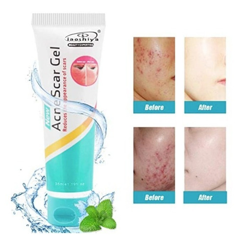 Imagen 3 de 5 de Crema Gel Contra Acne,espinillas,repara, Inflamacion Facial