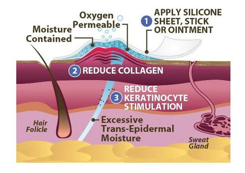 Scar Aid, Parche De Silicón Para Reducir Cicatrices Pequeñas