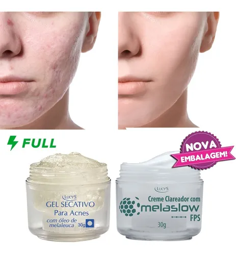 comprar Kit Gel Secativo Acnes + Clareador Facial Marcas De Espinhas
