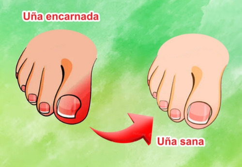 Uñas Enterradas, Corrector Uña Encarnadas