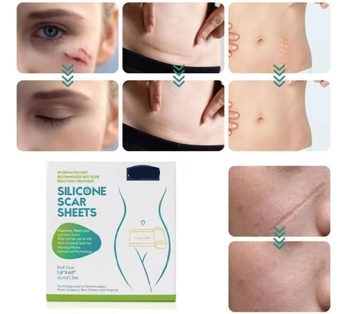 Hojas De Silicona Para Eliminar Cicatrices, Cinta De