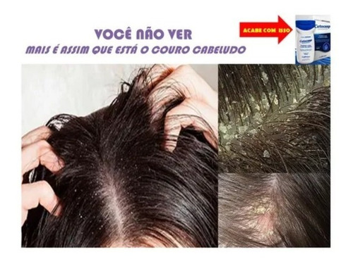 Shampo Cetocasp Cetoconazol Anticaspas Acabe Com As Caspas