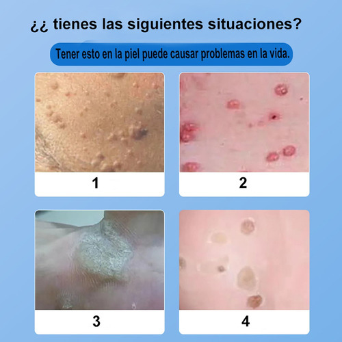 Líquida Para Eliminar Verrugas-eliminación Rápida De Verruga
