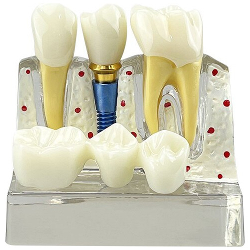 Modelo Didáctico Clear 4 Times Implant Teeth