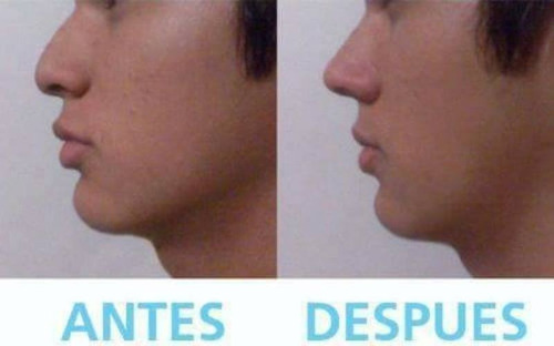Protesis Respingador Corrector De Nariz Premium®, Ultra Flex