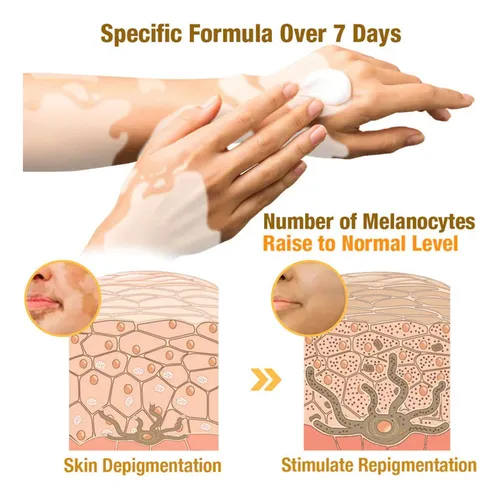 J Crema Para El Tratamiento Del Vitiligo De Veneno De Abeja
