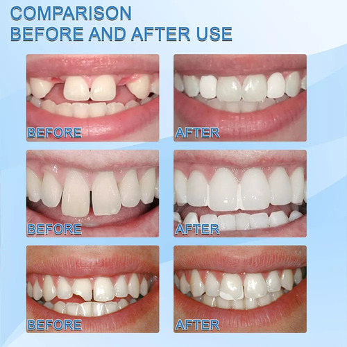 Q Reparación De Dientes Perlas Térmicas, Kit De Reparación