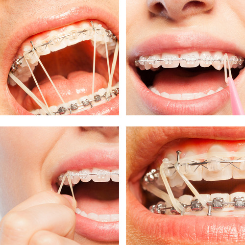 Ortodoncia Con Banda Elástica Dental, 500 Unidades