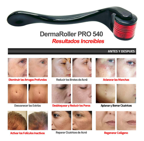 0.5mm Dermaroller Titanio Y Aplicador Para Barba Anticaída