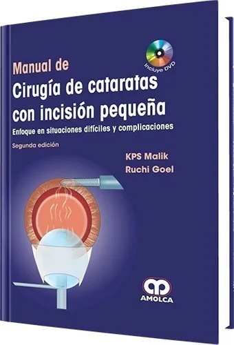 Manual De Cirugía De Cataratas Con Incisión Pequeña 2 Ed