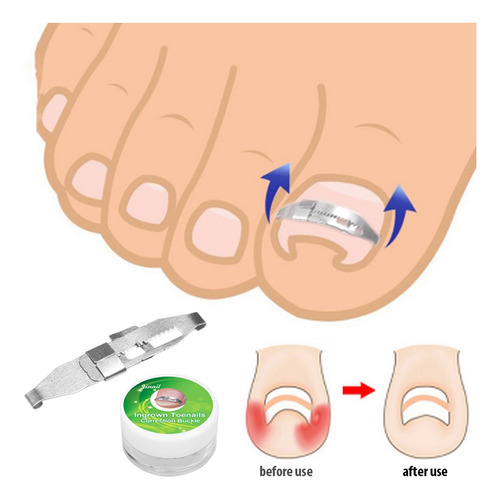 5 Unidades Corrector De Silicona De Uña De Encarnada