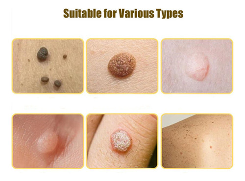 Crema Antipigmentaria Para Eliminar Las Verrugas Del Herpes,