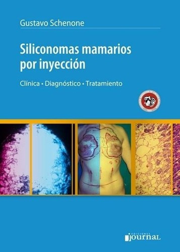Siliconomas Mamarios Por Inyección Schenone