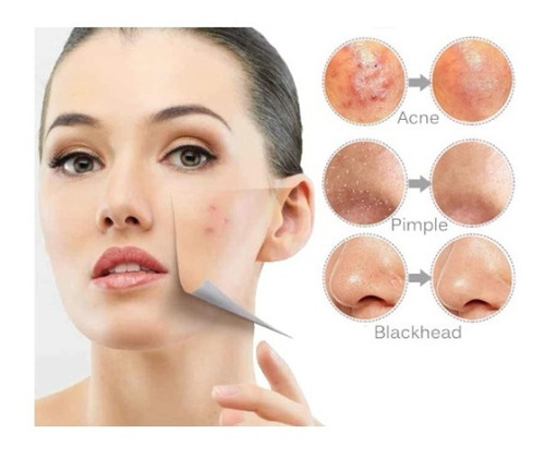 Acne Extractor Puntos Negros