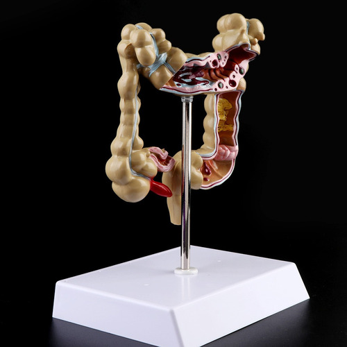 Para Para Modelo De Intestino Grueso Con Lesión De Colon