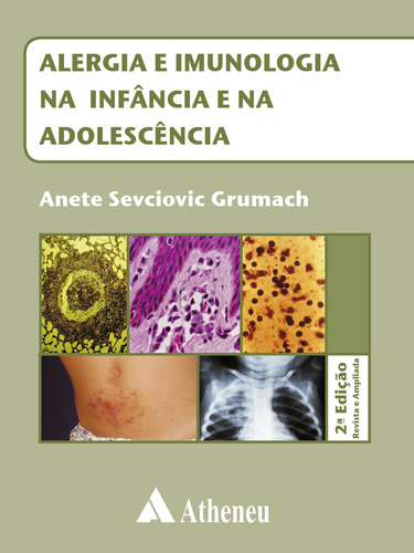 Alergia e imunologia na infância e na adolescência, de Grumach, Anete Sevciovic. Editora Atheneu Ltda, capa mole em português, 2008