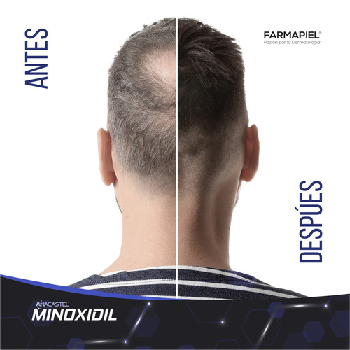 Imagen 5 de 8 de 2 Piezas Spray Anacastel Minoxidil 5% Cabello Y Barba 60 Ml