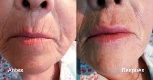 Imagen 3 de 6 de Remodelacion Facial Con Acido Hialuronico. 098 173 504