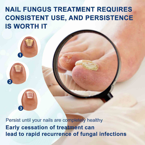 Para Melhorar As Unhas Dos Pés, Unhas E Pés Infectados 3ml