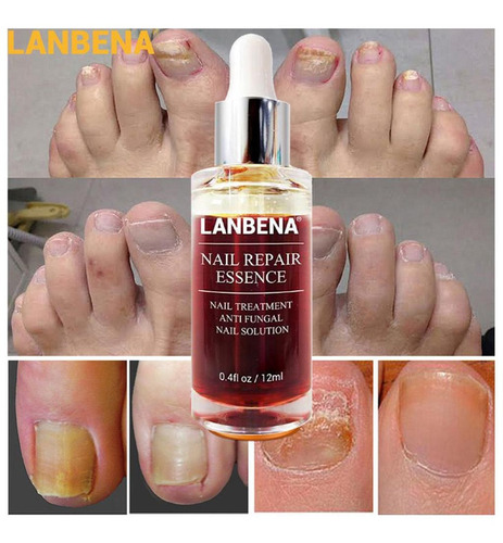 Tratamento De Unhas Fungo Remove Onicomicose Dedo Do Pé 15ml