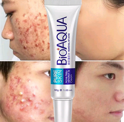 Creme Acne Bioaqua Secativo Remove Acne Cicatriz Espinhas Momento De Aplicação Dia/noite Tipo De Pele Oleosa